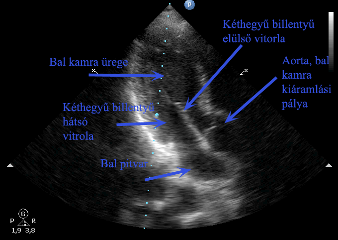 Csúcsi három üregi metszet - aorta kiáramlás. A video lejátszásához kattintson egyszer!