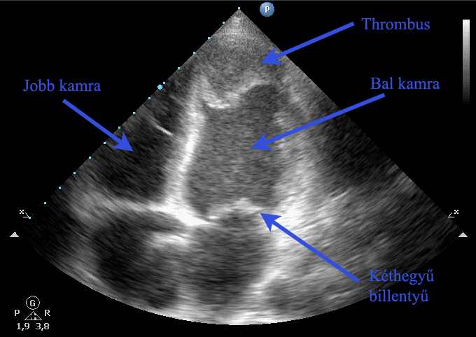 Szívüregi thrombus - A video megjelenítéséhez kattintson egyszer!