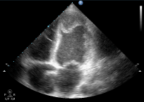 Szívüregi thrombus - 1. eset