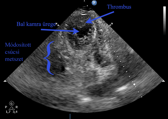 Szívüregi thrombus - A video megtekintéséhez kattintson egyszer!