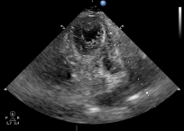 Szívüregi thrombus - 2. eset