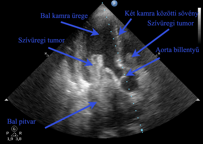 Szívüregi tumor - A video megtekintéséhez kattintson egyszer!