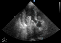 Szívüregi tumor - 3. eset